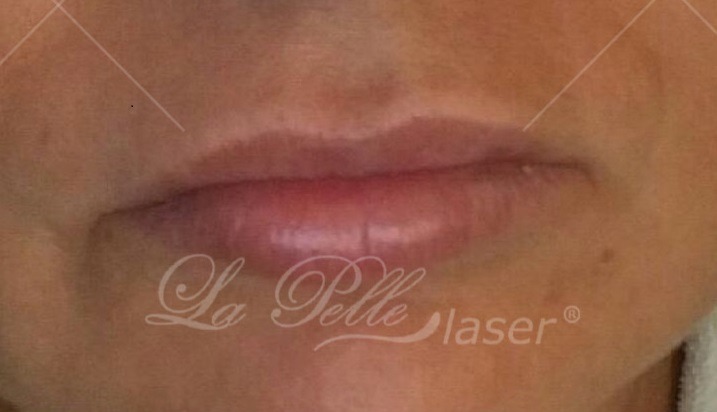 Kwas hialuronowy (Wypełnianie zmarszczek Powiększanie ust) - La Perle