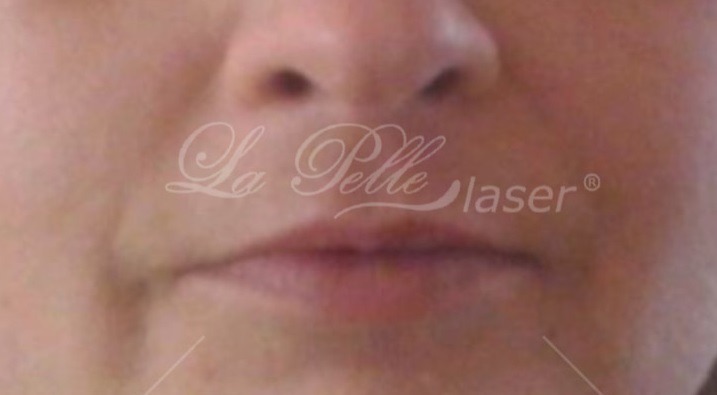 Kwas hialuronowy (Wypełnianie zmarszczek Powiększanie ust) - La Perle